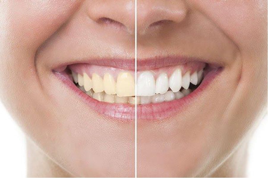 علت های زرد شدن دندان ها و تغییر رنگ آنها