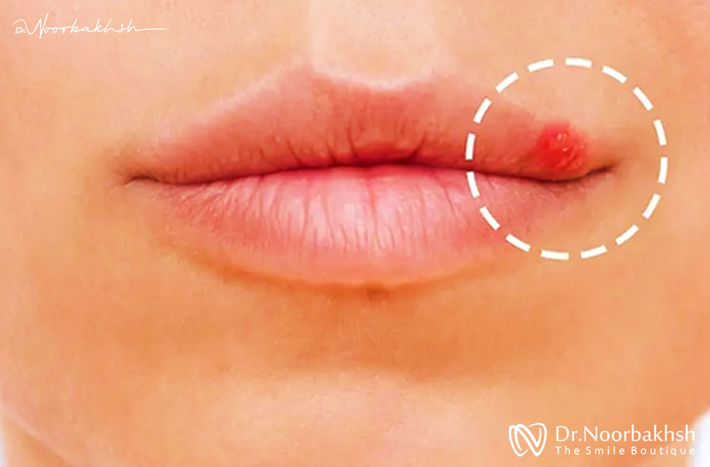 علائم و روش‌های تشخیص HPV دهانی