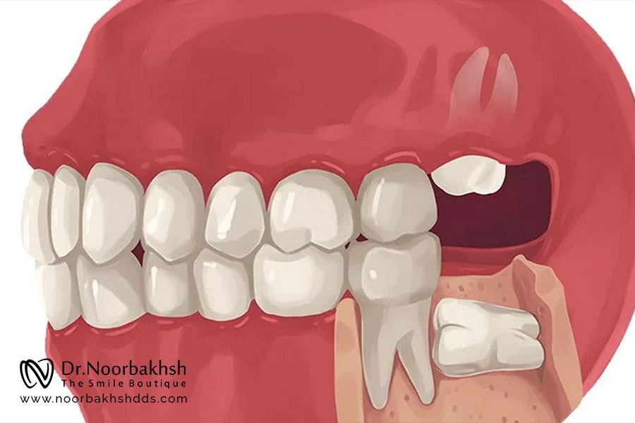 نحوه انجام جراحی دندان عقل چگونه است؟